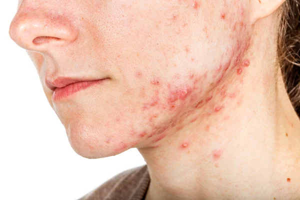 पिंपल के लिए बेस्ट फेस वॉश - 22 Best Face Wash For Pimples