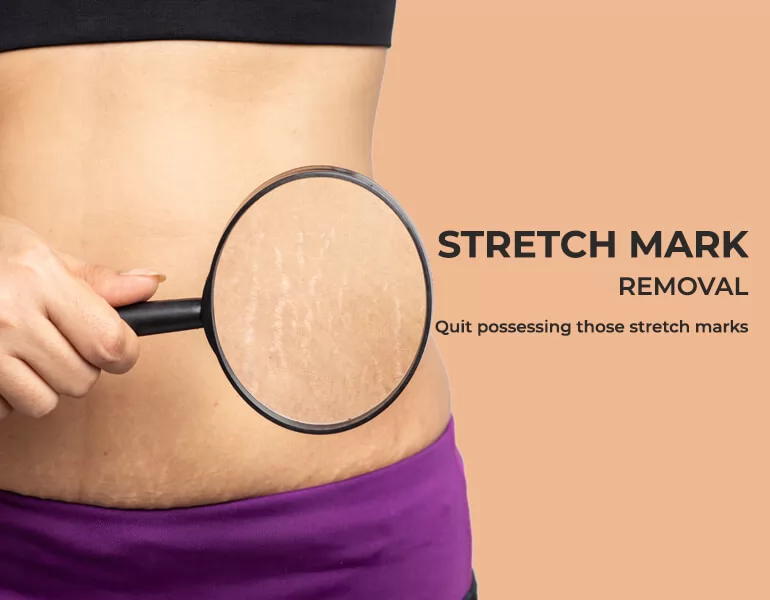  Best Stretch Mark Removal Cream In India