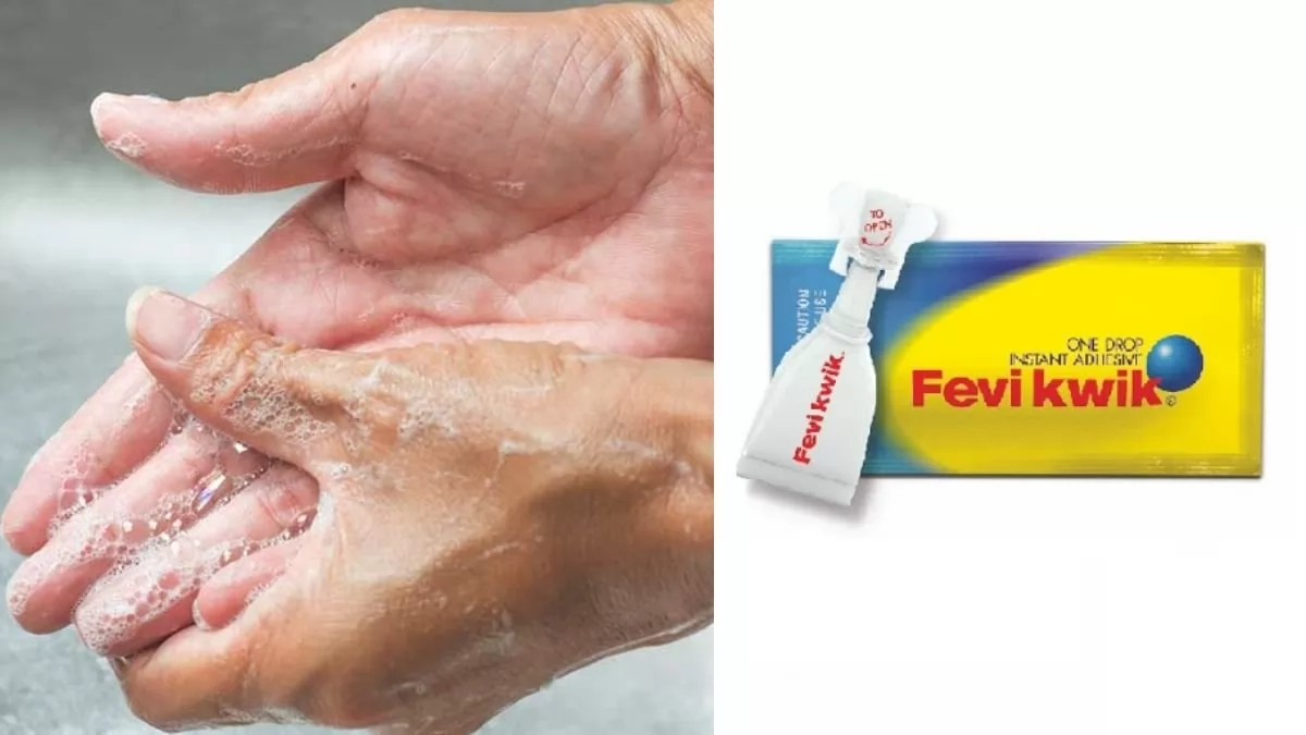 How To Remove Feviquick From Hand?