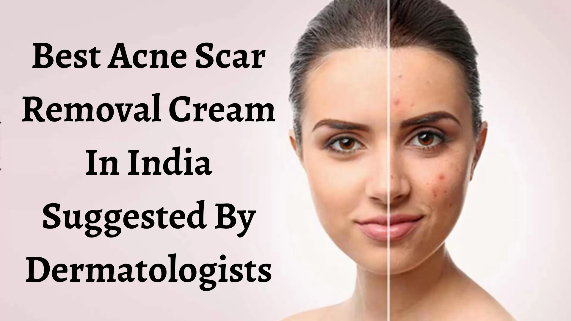16 Best Acne Scar Removal Cream In India Suggested By Dermatologists