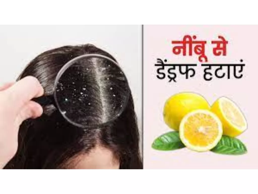 Dandruff Kaise Hataye (डैंड्रफ का रामबाण इलाज)