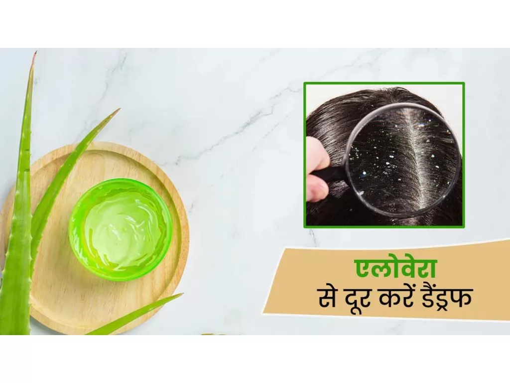 Dandruff Kaise Hataye (डैंड्रफ का रामबाण इलाज)